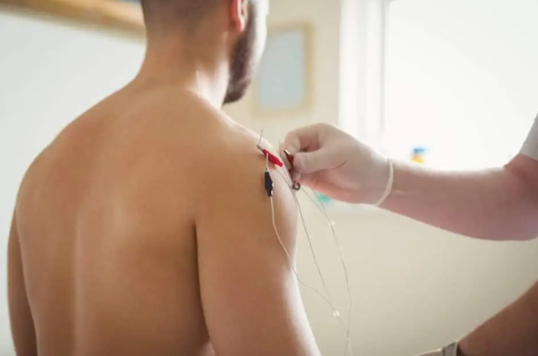 Dry needling and IMS therapy treatments at Brentwood Physio in Calgary